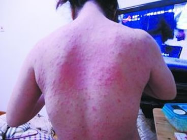 人身上被螨虫咬的图片(被咬5大症状和灭螨虫5大招)