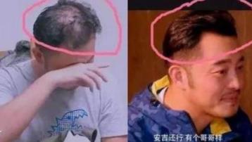 沙溢秃顶后又不秃顶了