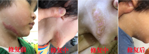 同济堂疤痕修复,疤痕对我们的生活有影响