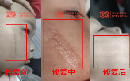 贵州同济堂疤痕修复,凹陷性疤痕的原理